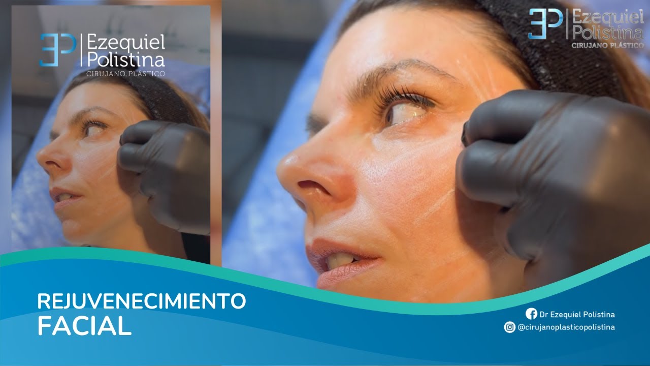 Bioestimuladores Radiesse by Cirujano Plástico Polistina
