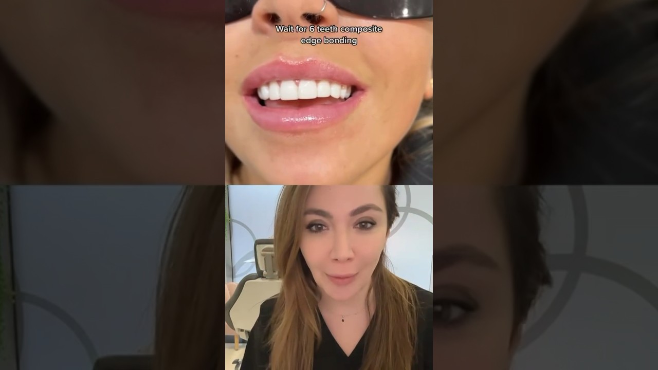 Composite Bonding To Improve Edges Of My Teeth!