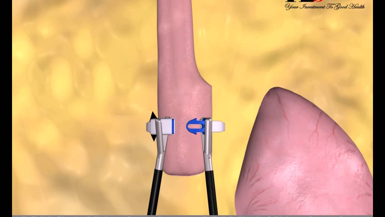 Exploring the Banded Gastric Bypass: A Comprehensive Guide