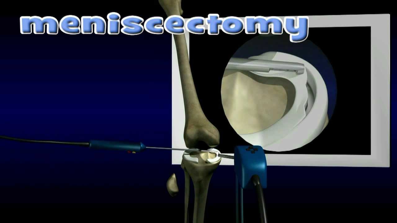 Meniscus Repair and Meniscectomy