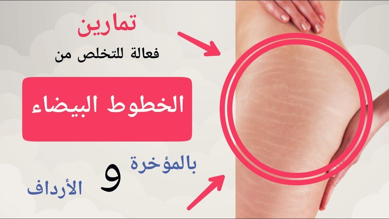 تخلصي من الخطوط البيضاء بالمؤخرة والأرداف ( لن تصدقي النتيجة )