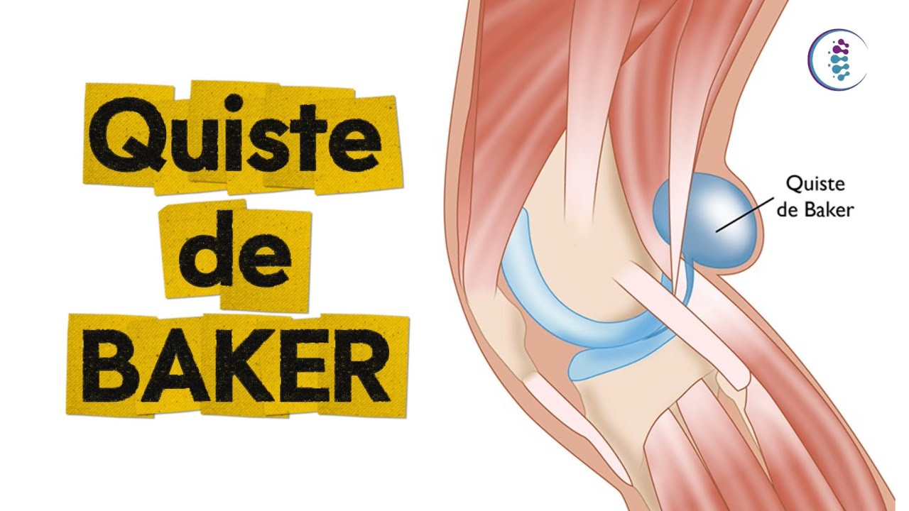 Quiste de Baker 🤔 Aquí te explicamos, qué es, síntomas y tratamientos 🙌🏻✨
