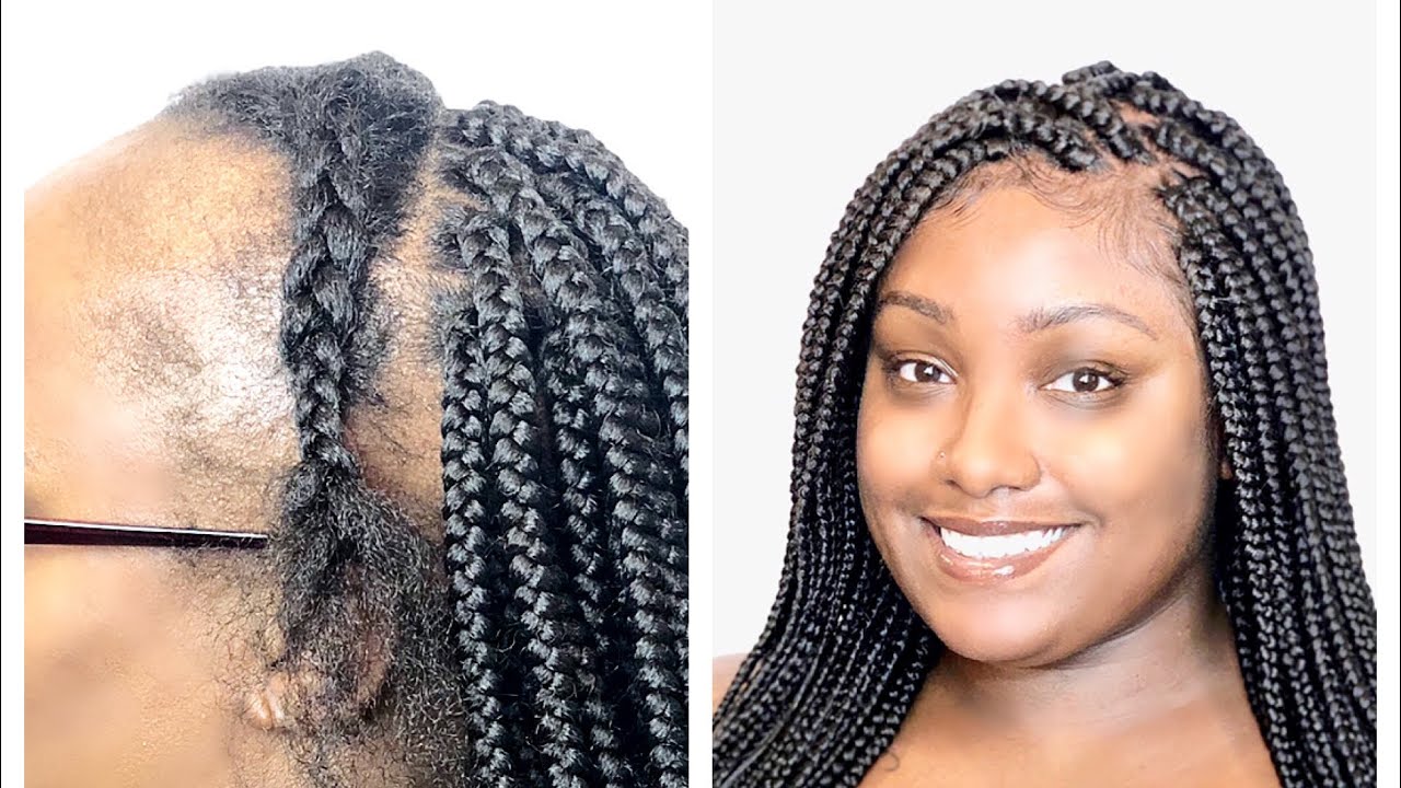 LACE FRONTAL BOX BRAIDS FOR THINNING HAIR - NO WIG NEEDED!