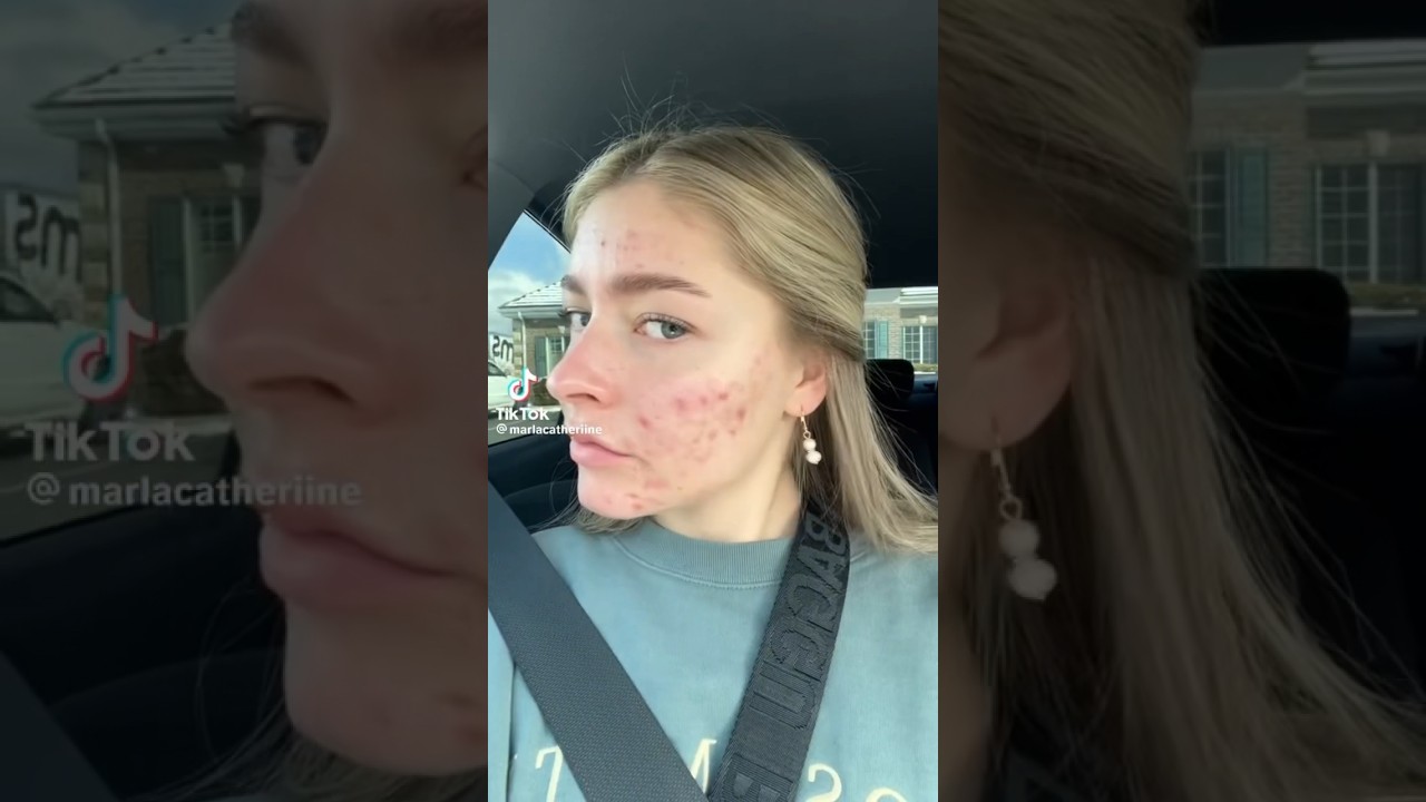 before & after 7 months of accutane