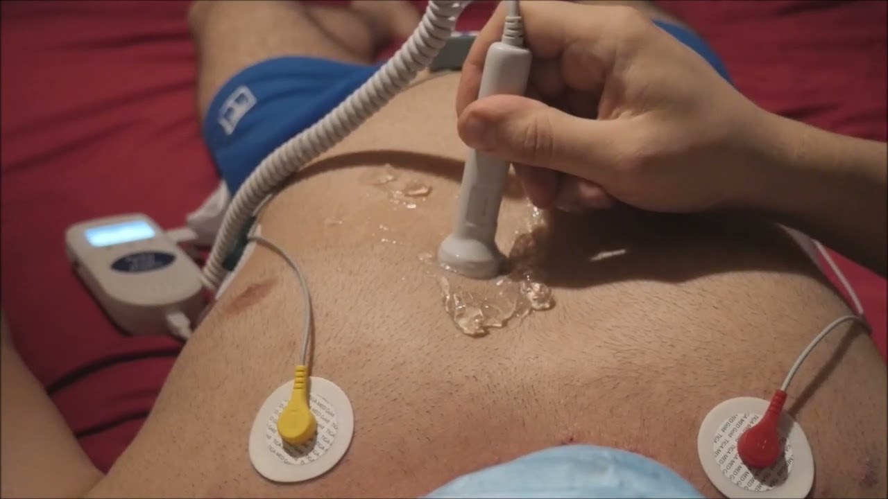 ECG of my heart and doppler