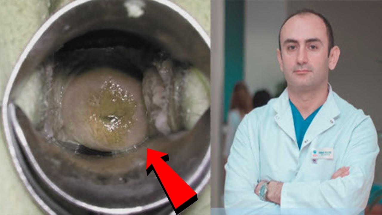 Qadında uşaqlıq boynu qısadırsa BUNLARI etməlidir!