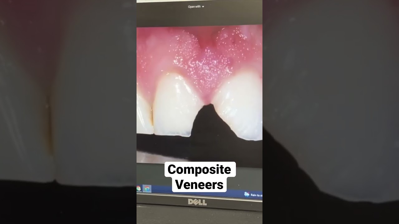Composite Veneers Before and After 