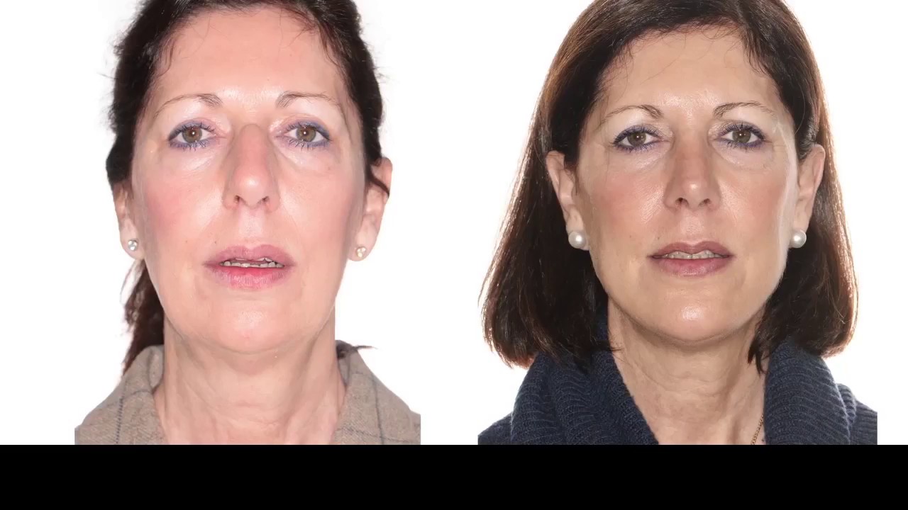 ELISABETH: Class II - Bimaxillary orthognathic surgery + Rhinoplasty