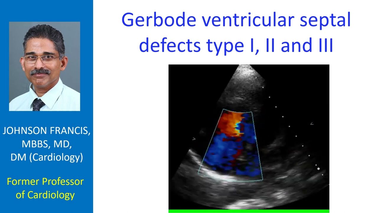 Gerbode ventricular septal defects type I, II and III