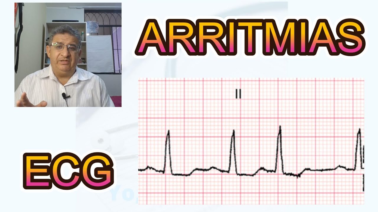 ARRITMIAS EN EL ECG. FACIL