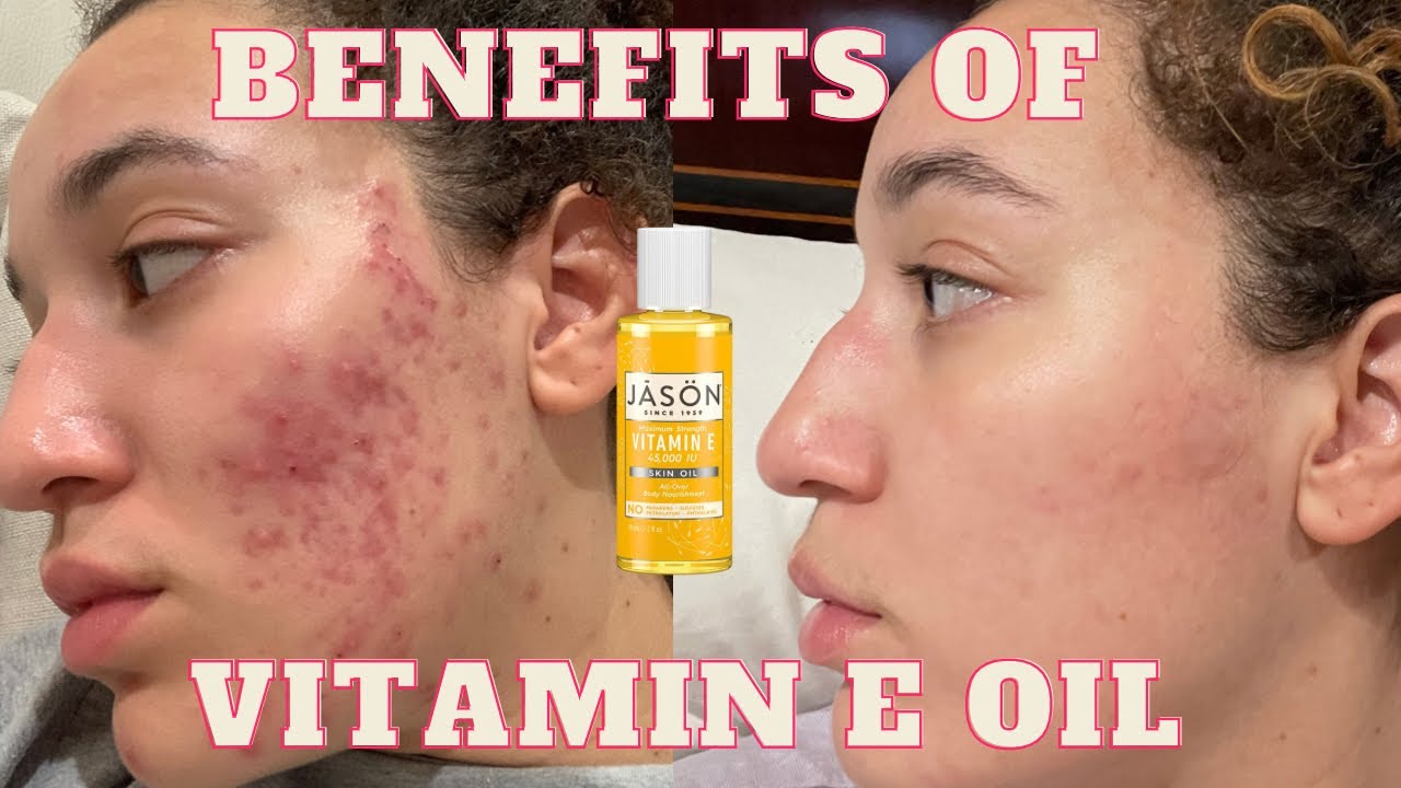 Vitamin E Oil for Acne Scarring, Dry & Flaky Skin
