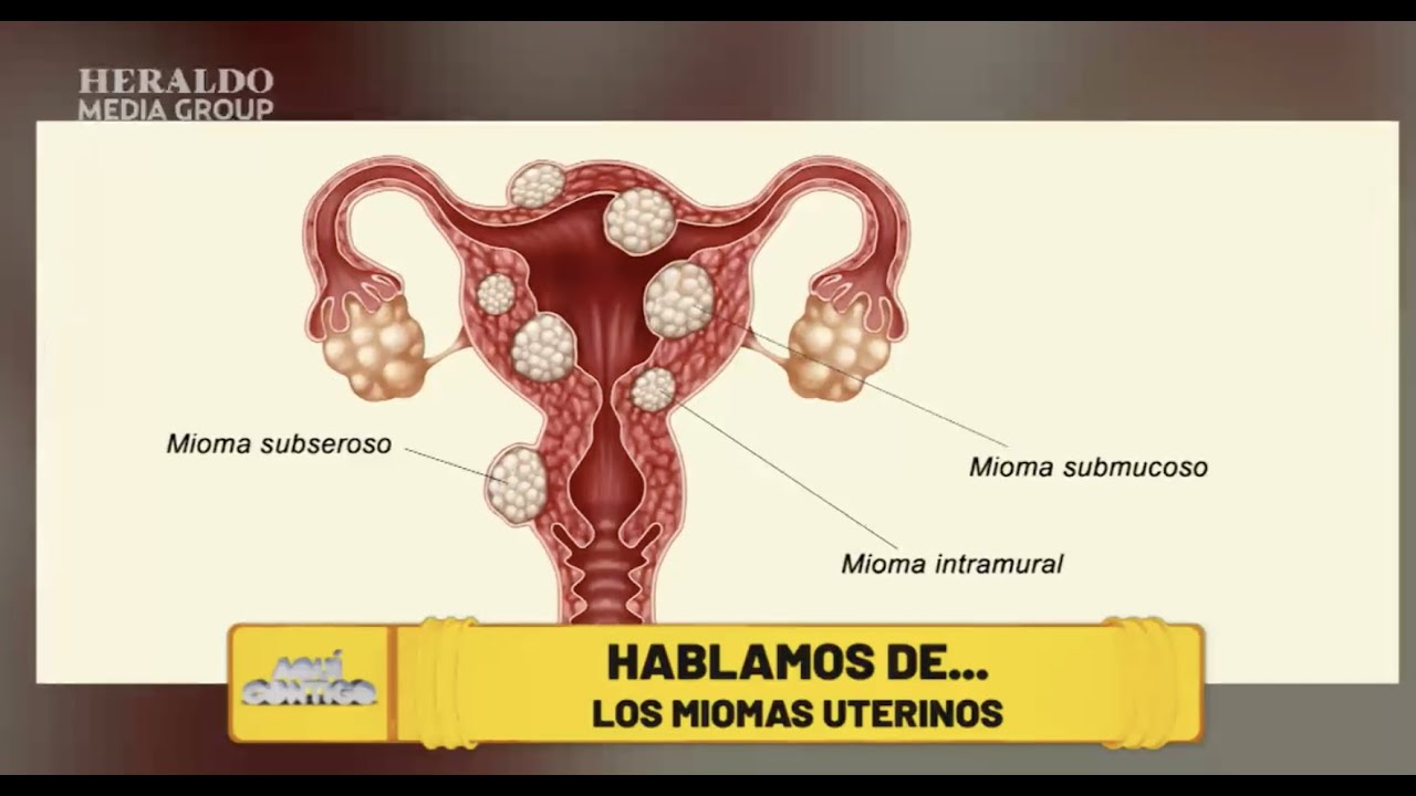 #MédicoH | #MiomasUterinos: ¿Cómo identificarlos y tratarlos?