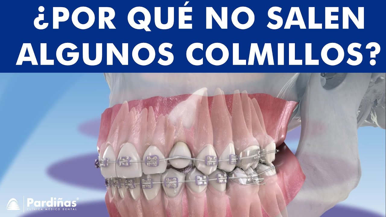 COLMILLOS INCLUIDOS o retenidos - Qué hacer si no salen los CANINOS u otros dientes ©