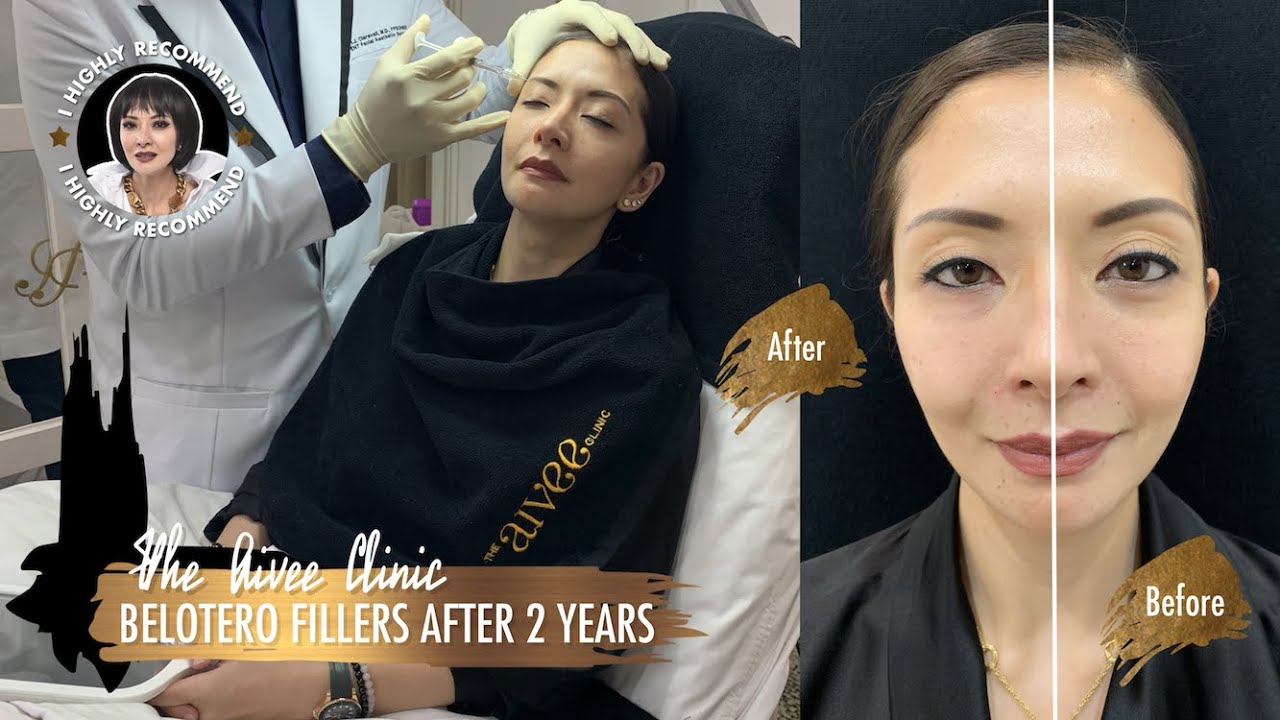 UPDATES: BELOTERO FILLERS AFTER 2 YEARS | THE AIVEE CLINIC | Cat Arambulo-Antonio