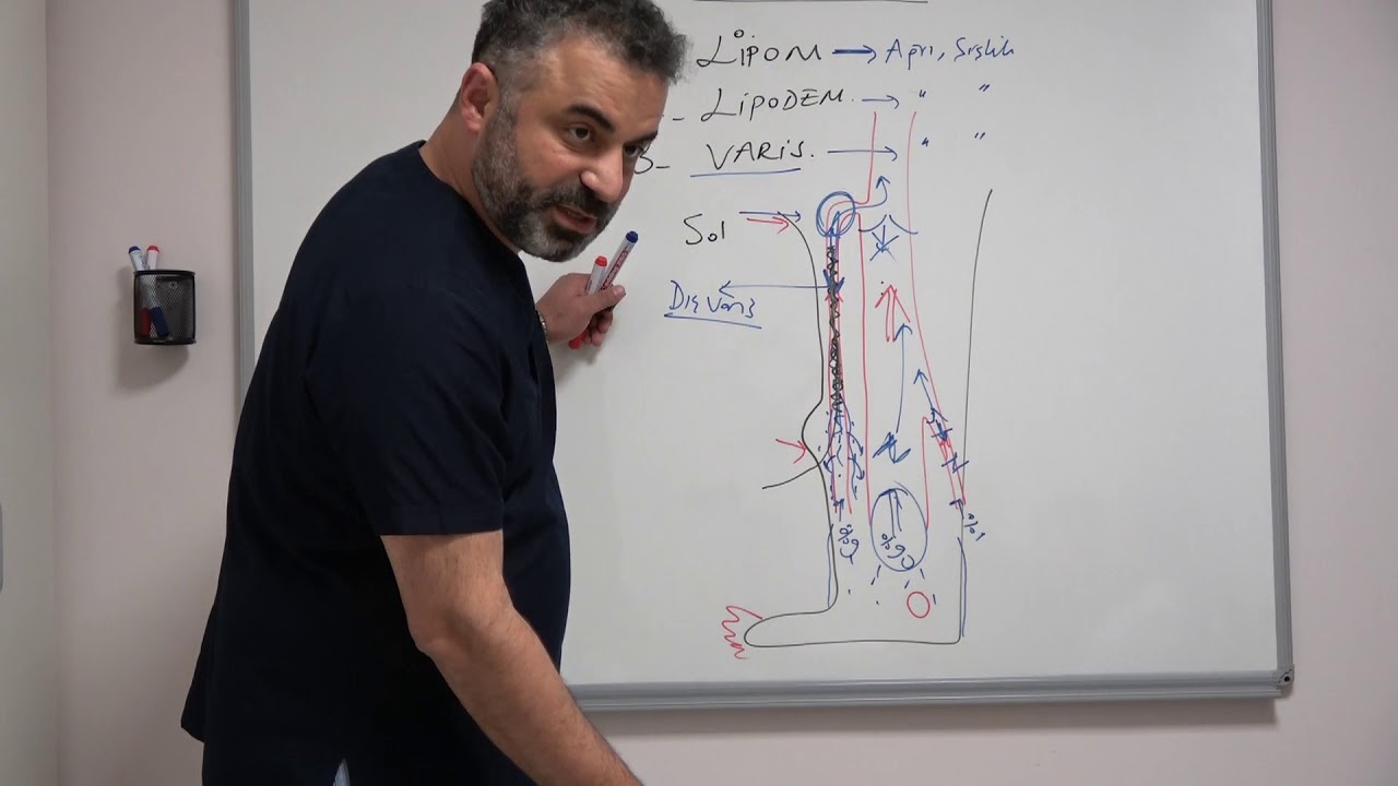 Lipom ve Yağ Bezeleri, Bacakta Şişlik ve Ağrılar – Prof. Dr. Ahmet Akgül