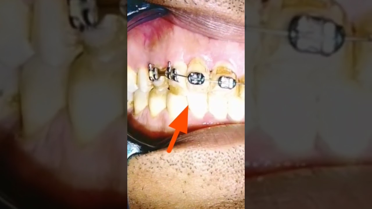 قبل وبعد إزالة التقويم