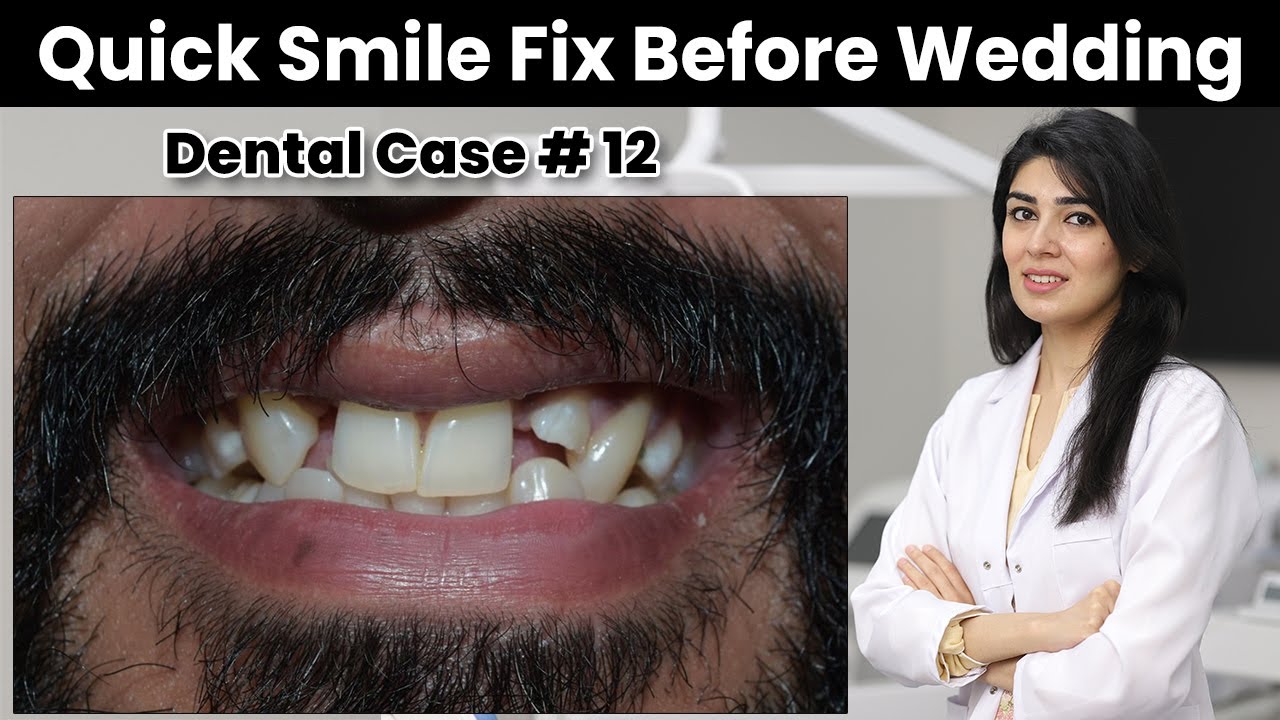 Quick Smile Fix One Day Before Wedding | Dental Case # 12 | Teeth Gap | Veneers | Dental Aesthetics