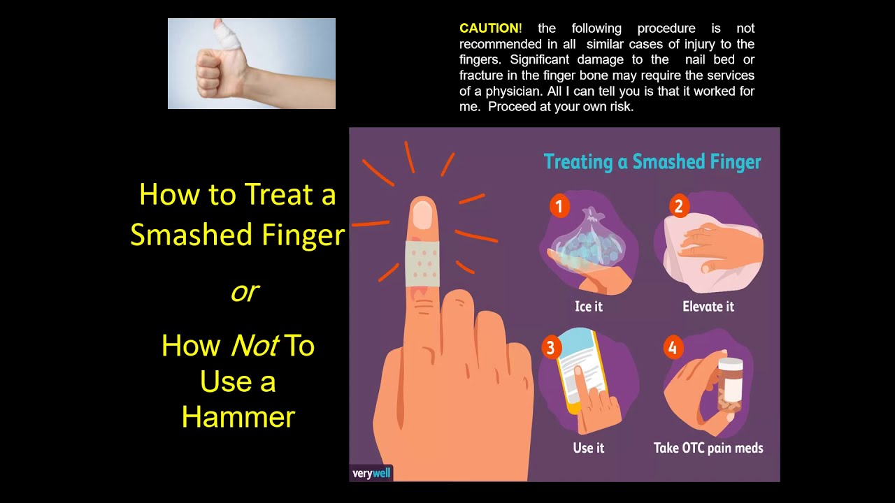 How to treat a smashed finger that get hit