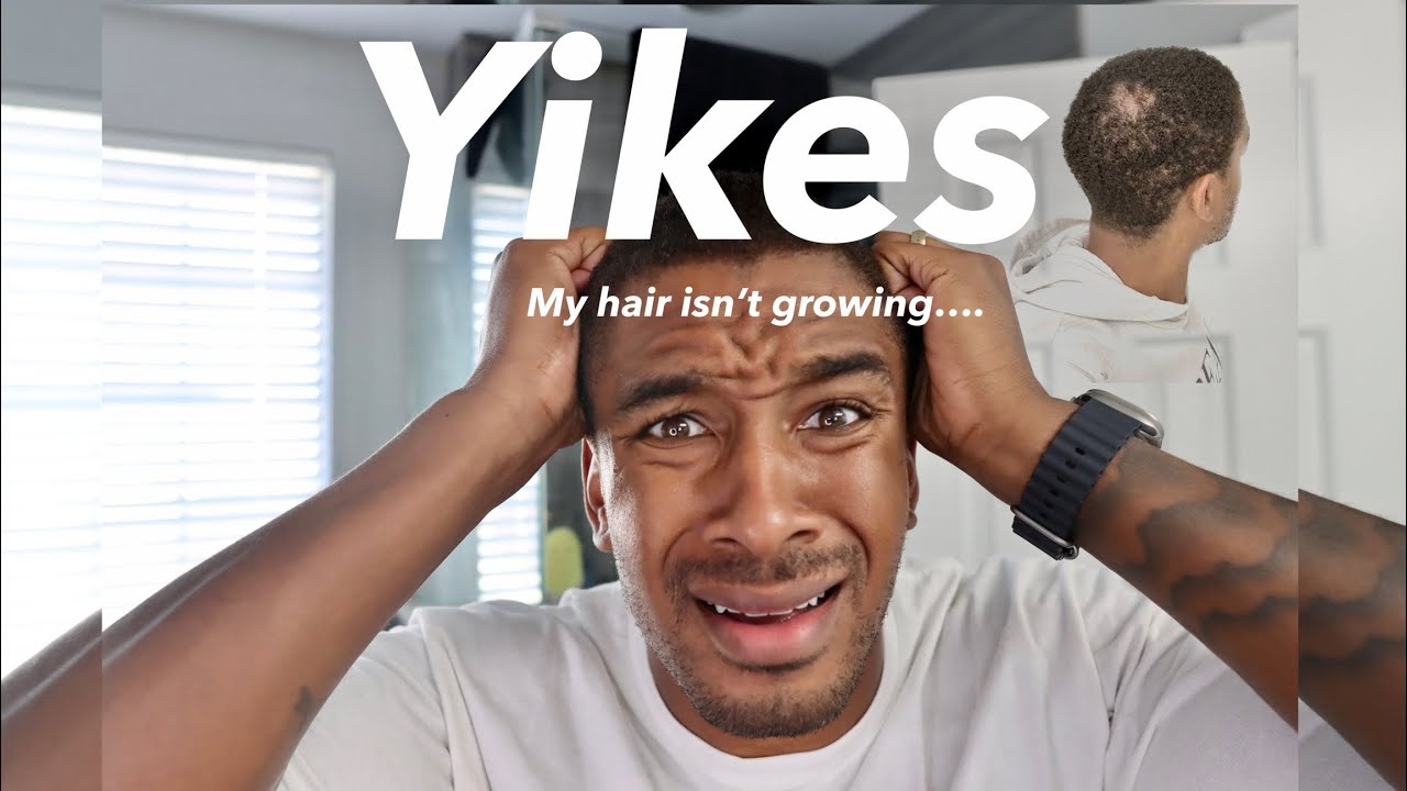 Hair Growth Journey | 160 Day Growth Update #minoxidil  | I'm Going Bald! 😢😲 #dreadlockjourney