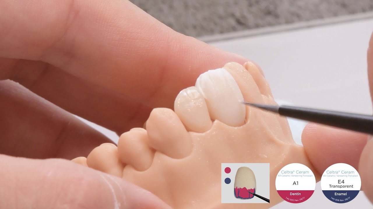 CEREC Tessera Partial Veneering in Cut-Back Procedure