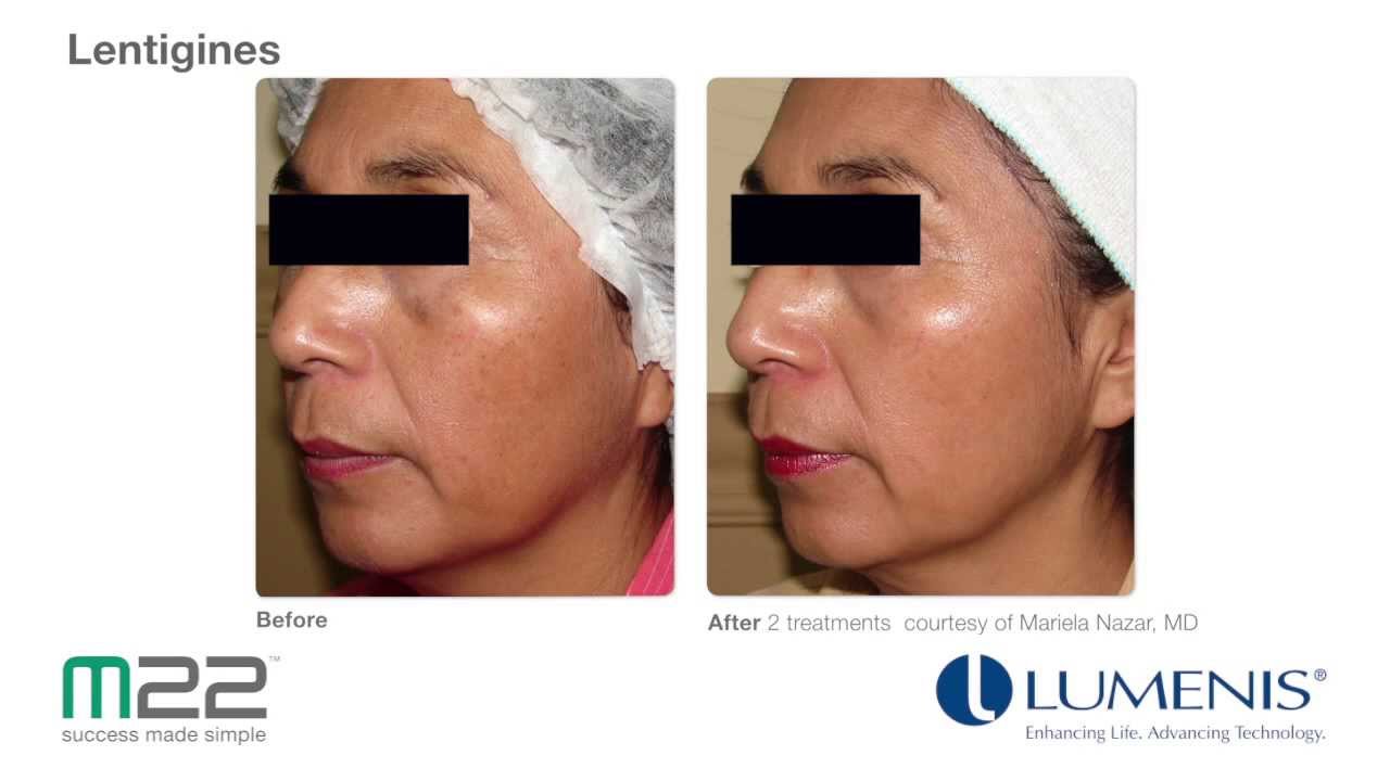 M22 IPL Photofacial Results Video