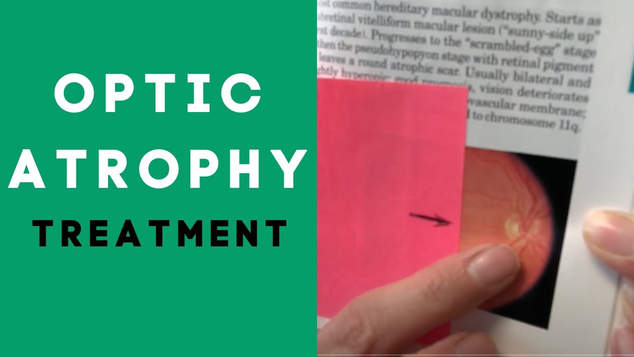 What Is Optic Atrophy?