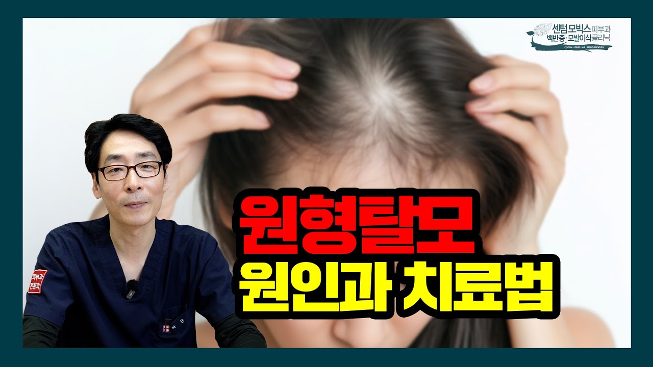 여성 원형탈모, 원인과 치료법