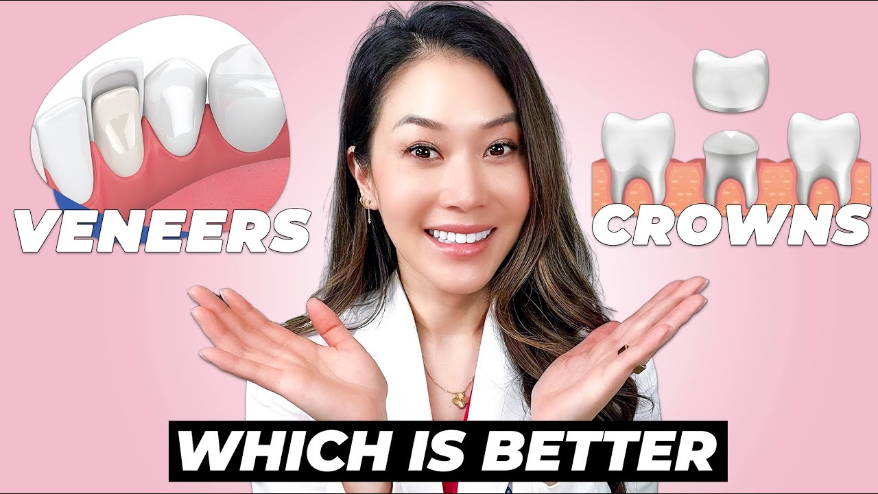 Crowns vs. Veneers— Which Is Best?