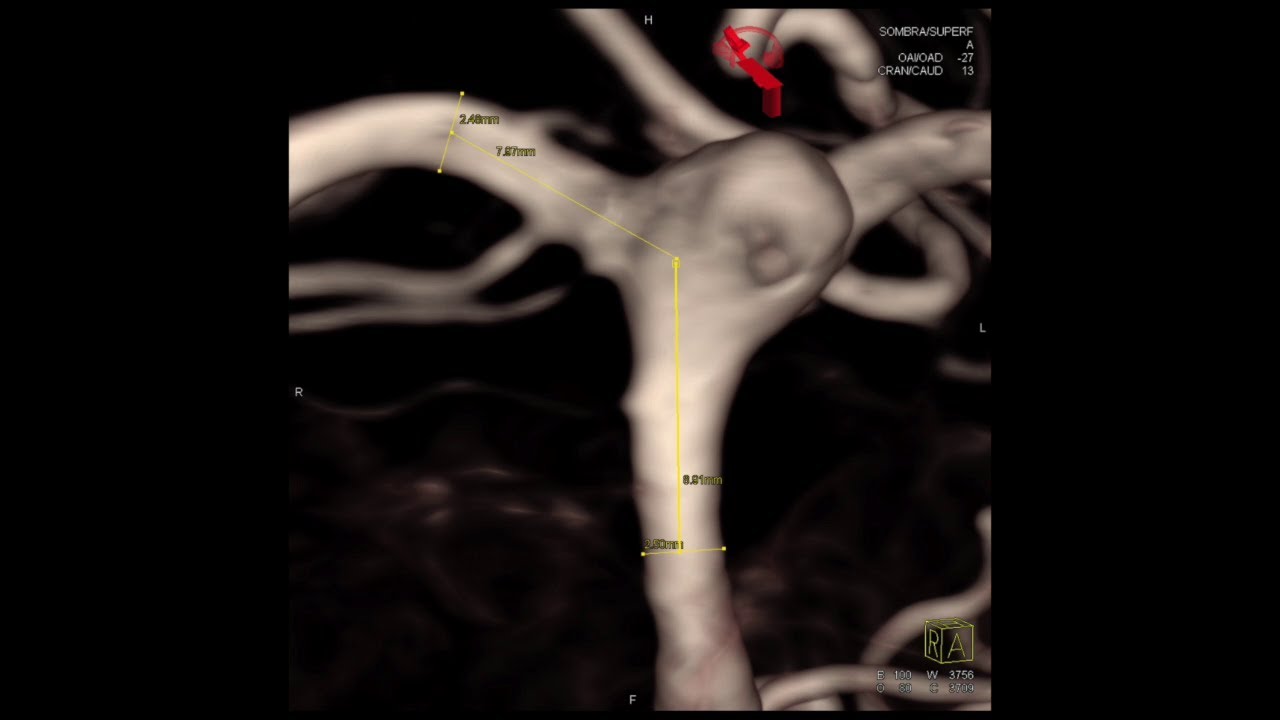 Aneurysm Basilar Top - Stent