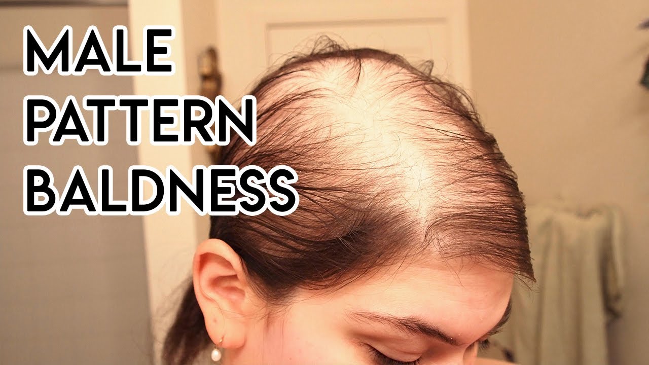 Treating Male Pattern Baldness