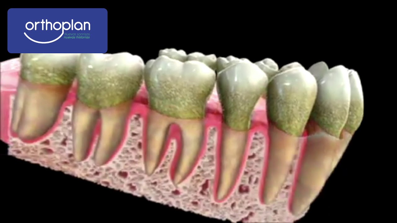 Orthoplan - Tratamiento de Periodoncia