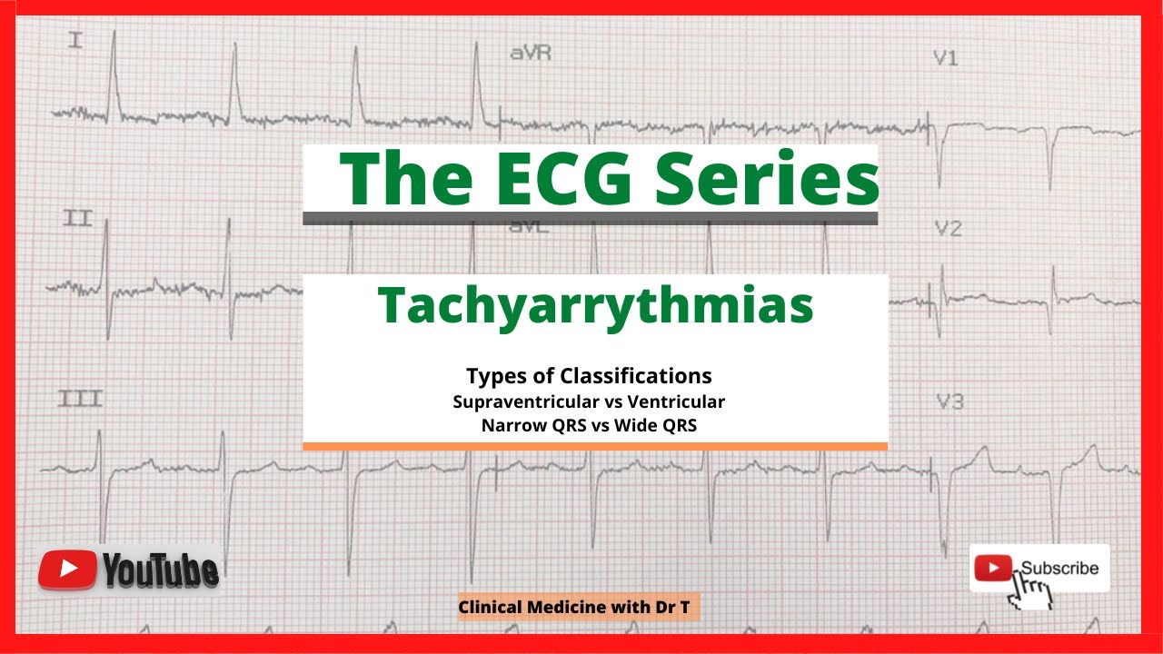 The ECG Series//Tachyarrythmias//QRS Complex Classification