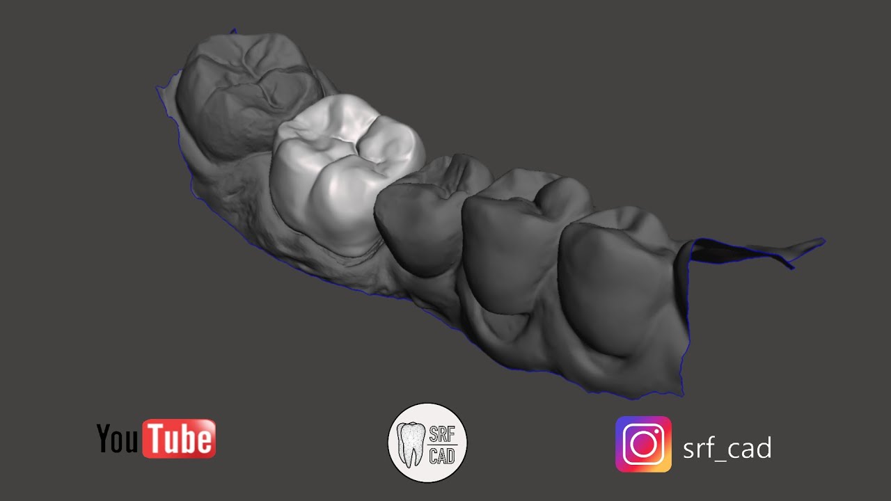 MESHMIXER DENTAL : Tutorial come creare un provvisorio temporary C&B