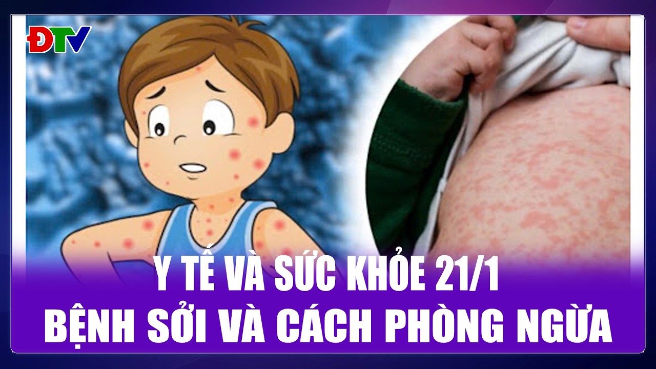 Bệnh sởi và cách phòng ngừa | Y tế và sức khỏe 21-1-2026 | Điện Biên TV