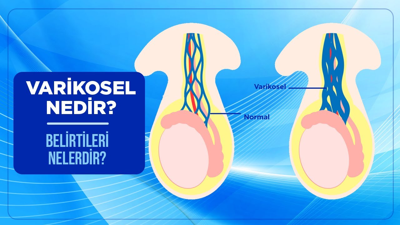 Varikosel Nedir? Belirtileri Nelerdir? Varikosel Tedavisi ve Ameliyatı Nasıl Yapılır?