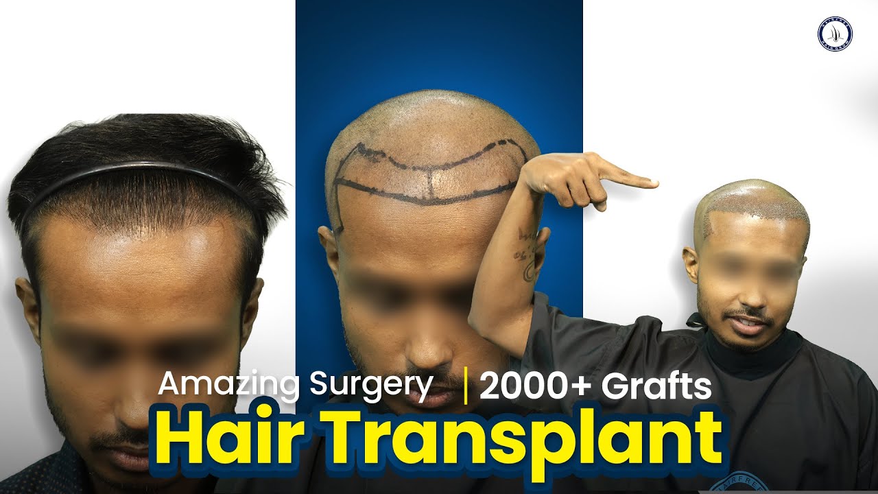 2000 Grafts Hair Transplant Surgery | Grade 2 Baldness | Hairfree & Hairgrow Bangladesh