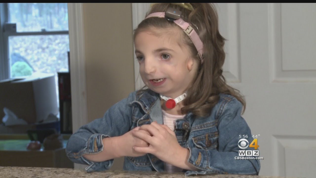 'Wonder' Movie Touches Home For Haverhill Girl With Treacher Collins Syndrome
