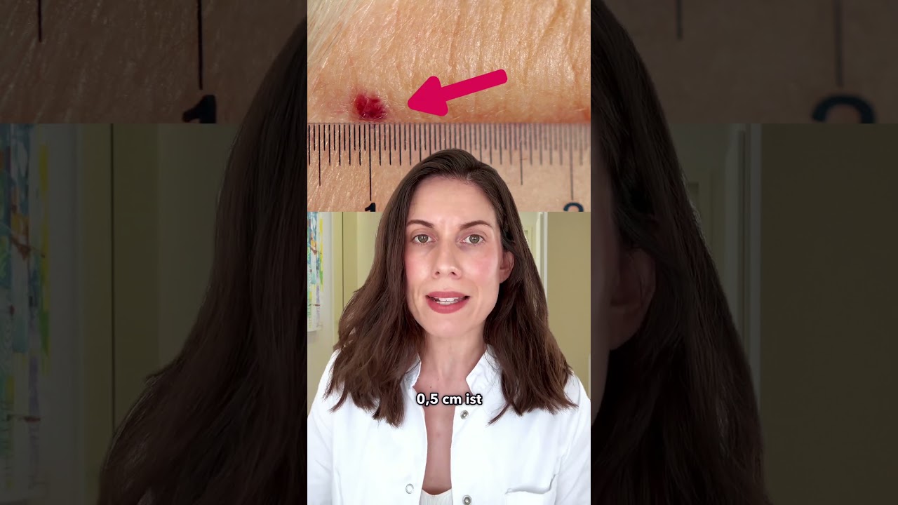 Gef&auml;hrliche Muttermale zu Hause entdecken: ABCDE Regel | DERMAFY #shorts
