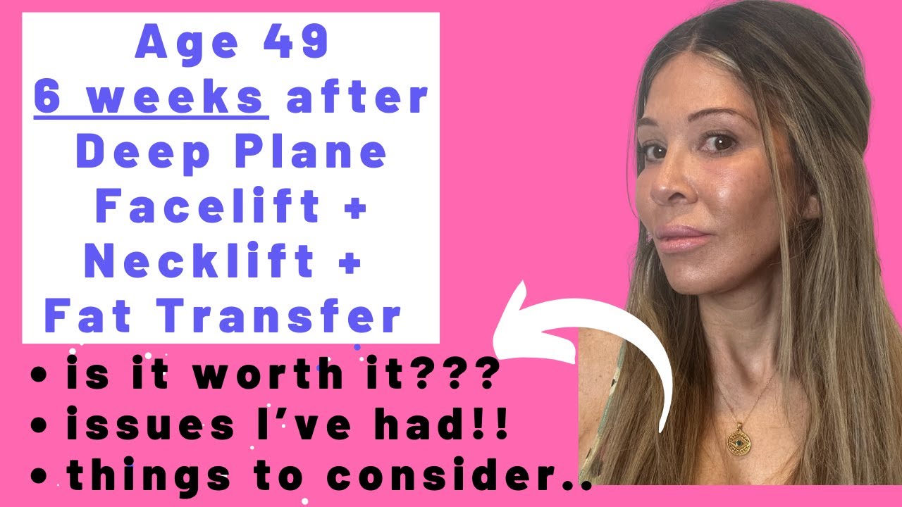 Age 49: 6 weeks after Deep Plane Facelift, Necklift, Fat Transfer. Issues, worth it, things to know