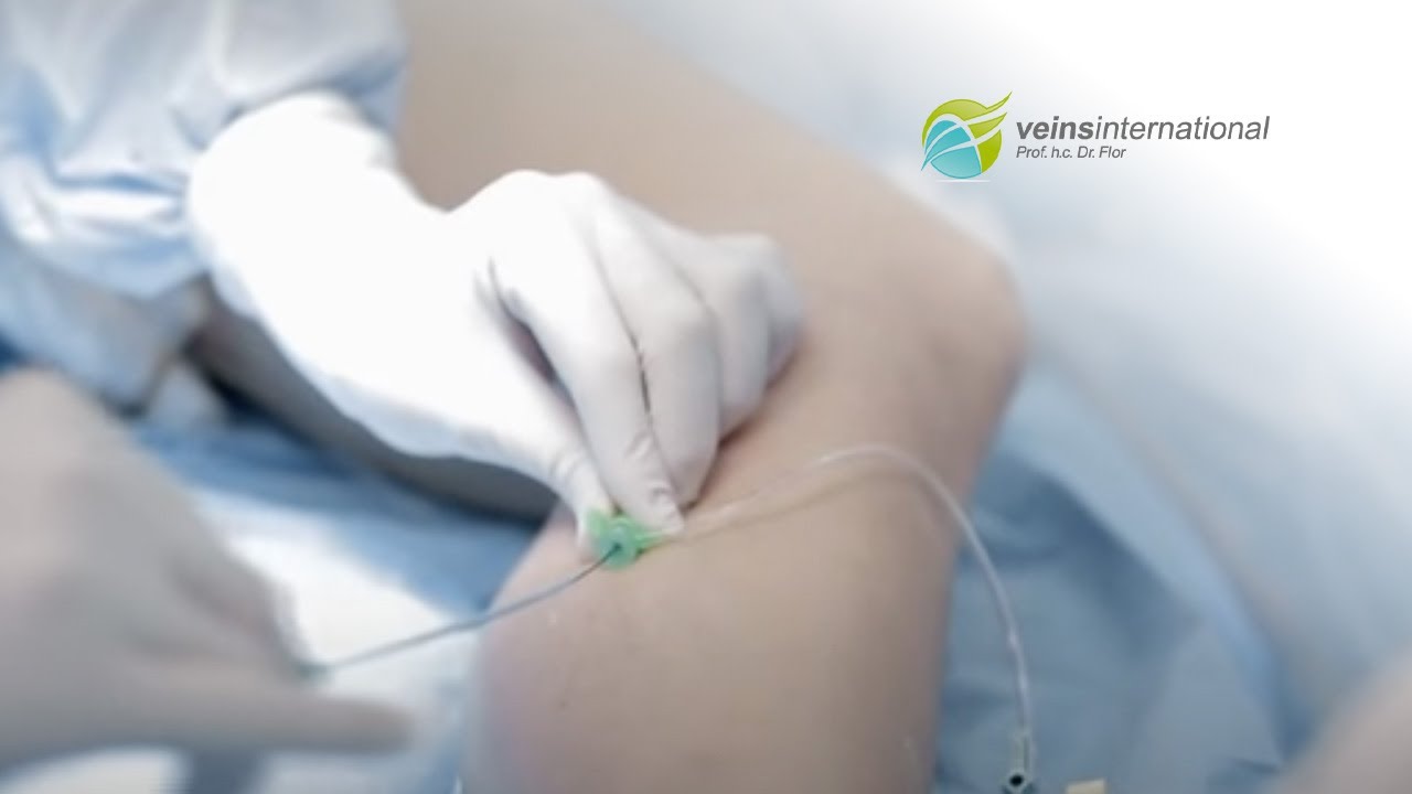 Moderne Laserbehandlung von Krampfadern: Sicher und schmerzfrei