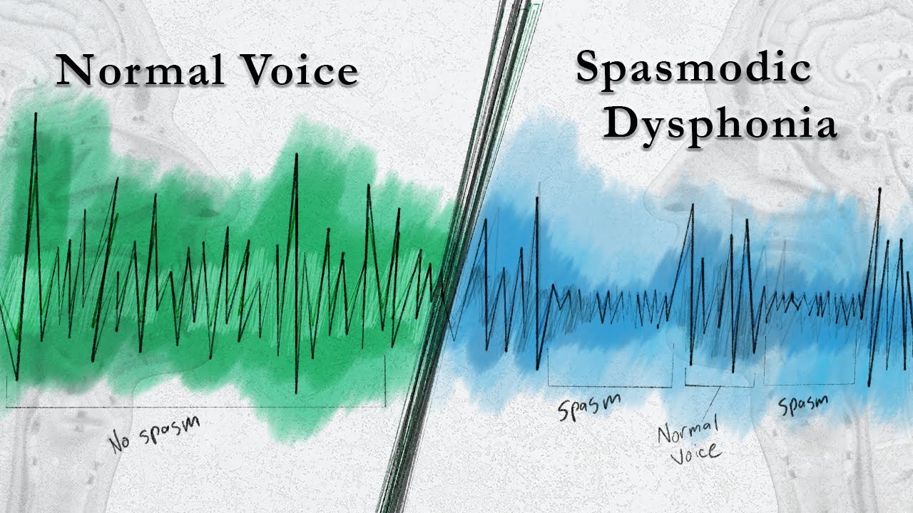 Spasmodic Dysphonia | A Peculiar Voice Disorder - Part 1