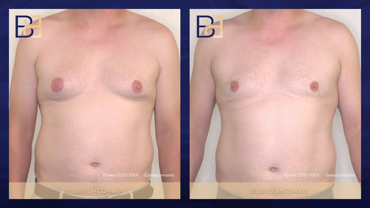 Pseudo-gynaecoamstia with Small Gland Component [BB grade 2b] {Patient 2021-7001} Before & After