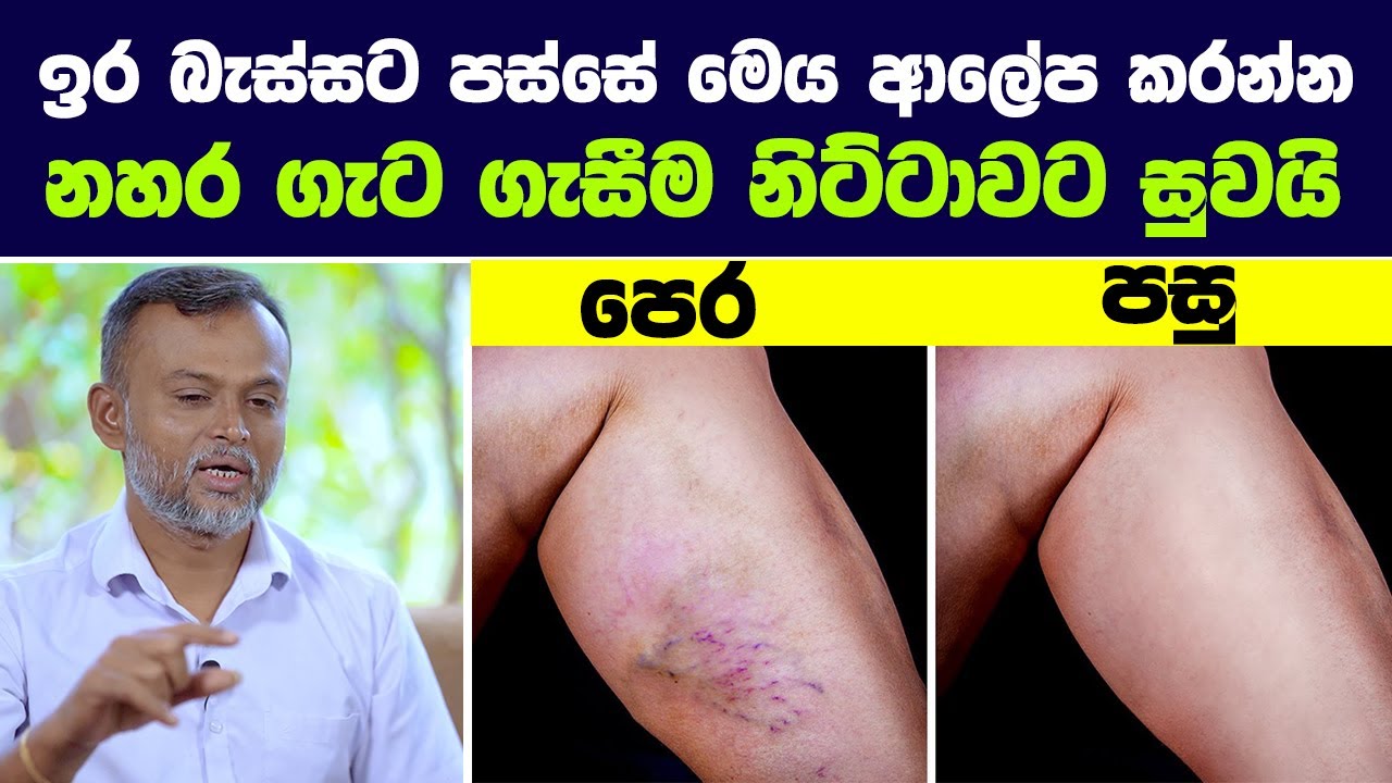 සැත්කම් වලට යන්න එපා, නහර ගැට ගැසීම නිට්ටාවට සුව කරන්න පුළුවන් | Varicose Veins