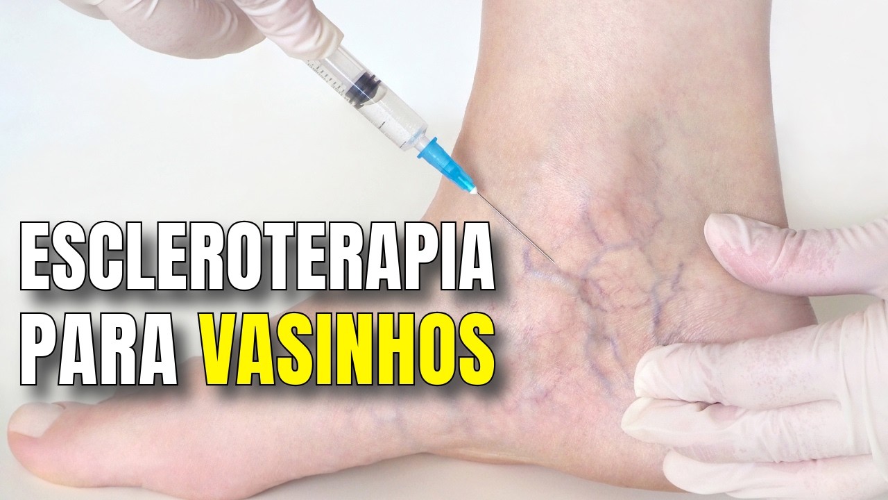 Escleroterapia, secagem de vasinhos, aplicações nas varizes: laser e esclero