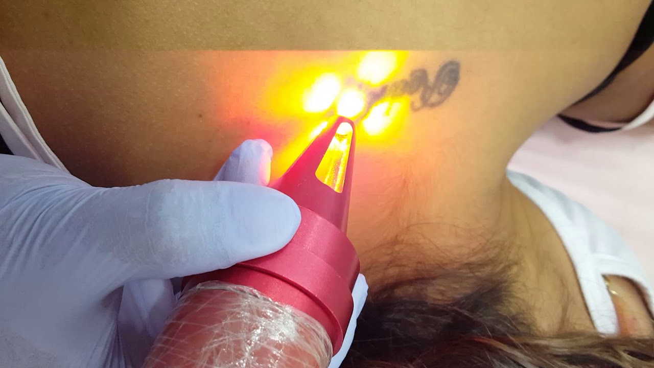 Remoção de tatuagem e despigmentaão d aquilagem definitiva e sobrancelha