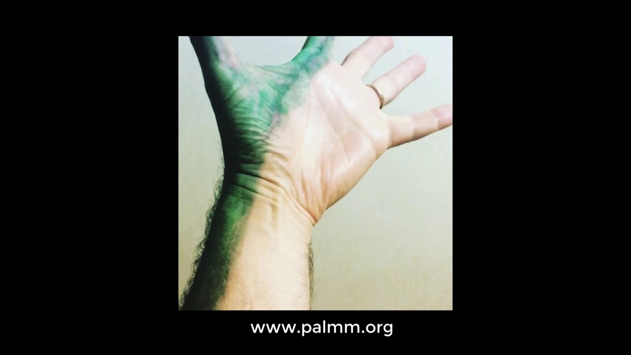 C6 Nerve root  lesion