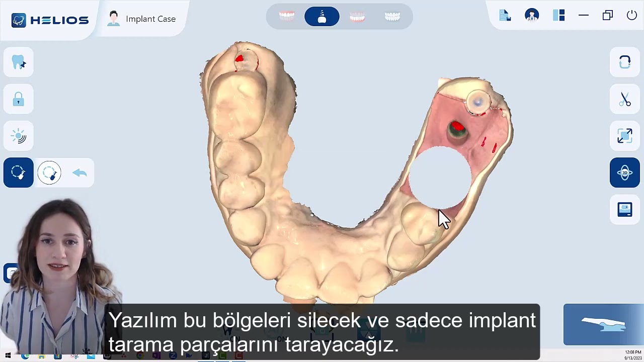 Eighteeth Helios 500 İmplant Tarama İş Akışı
