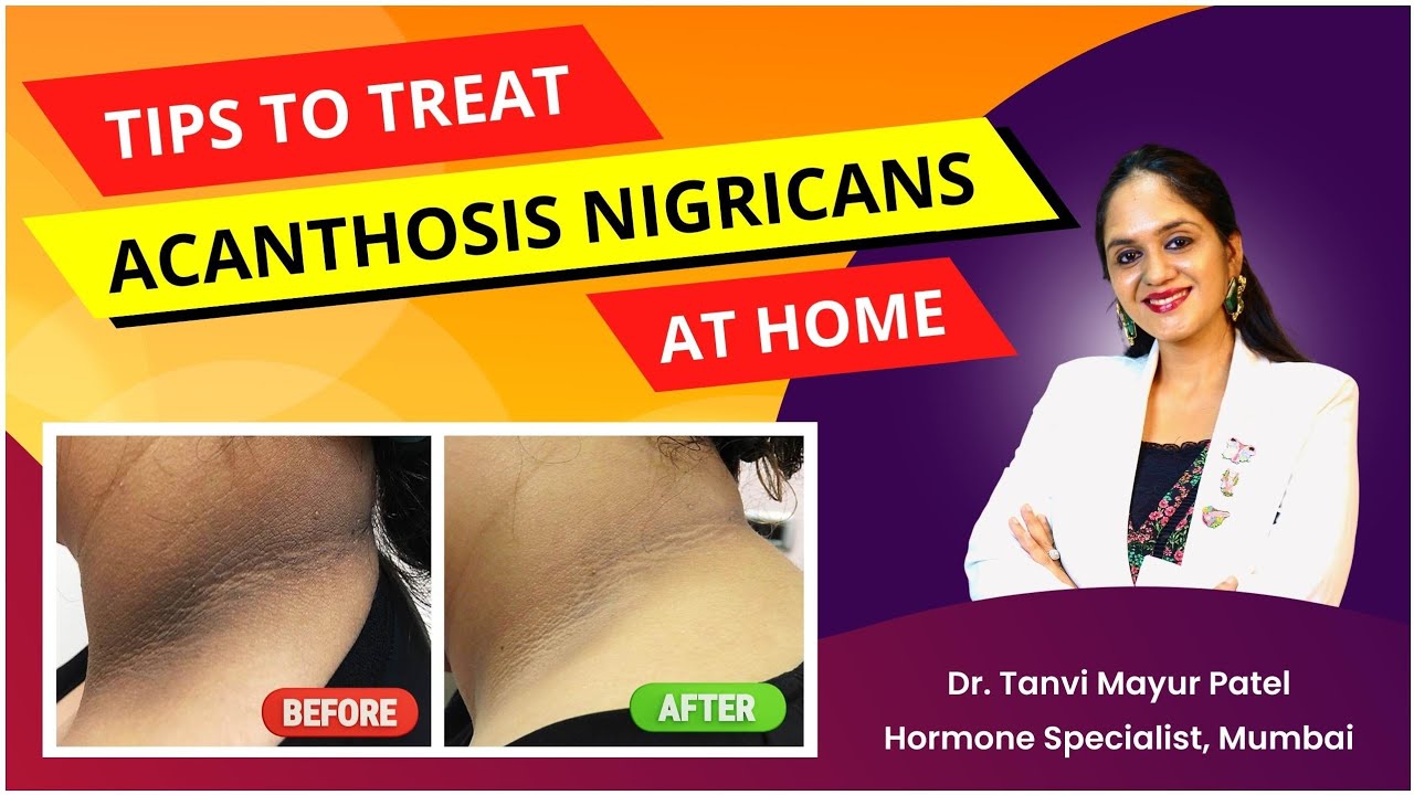 Dark Patch (Acanthosis Nigricans) Treatment by Dr Tanvi Mayur Patel
