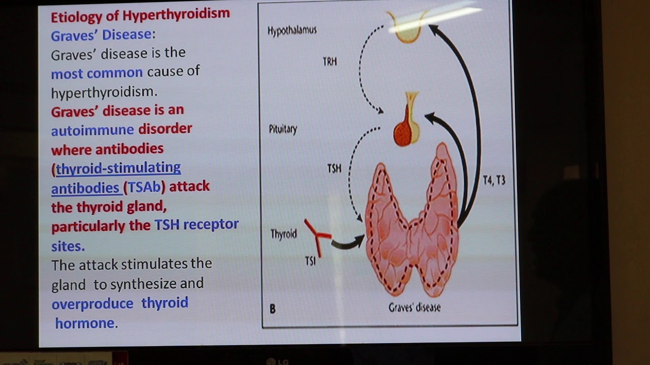 Thyroid disorders. Part I (Hyperthyroidism). By Dr. Dheyaa Jabbar