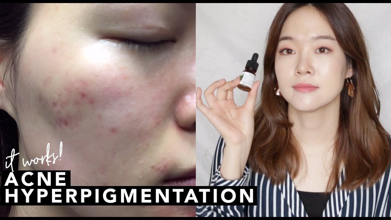 It actually works! Getting rid of acne hyperpigmentions | 여드름 상처 & 색소침착 없애주는 제품!